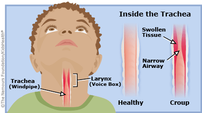 croup